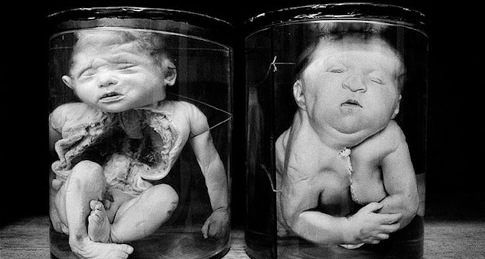 放射能と奇形児　旧ソ…