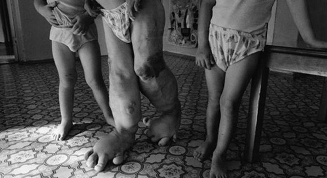 放射能と奇形児　旧ソ…