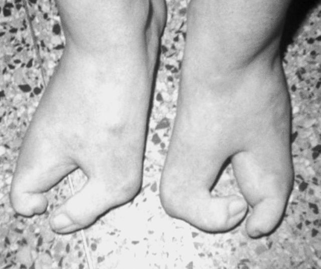 放射能と奇形児　旧ソ…