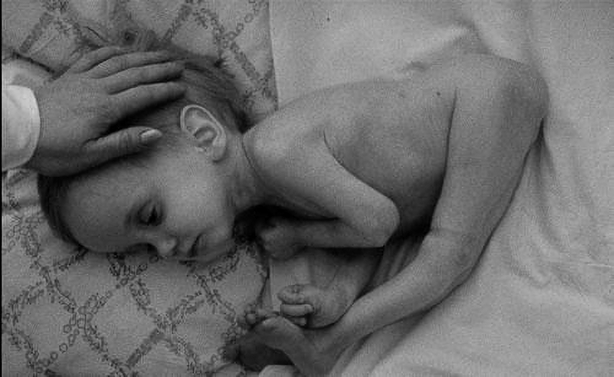 放射能と奇形児　旧ソ…