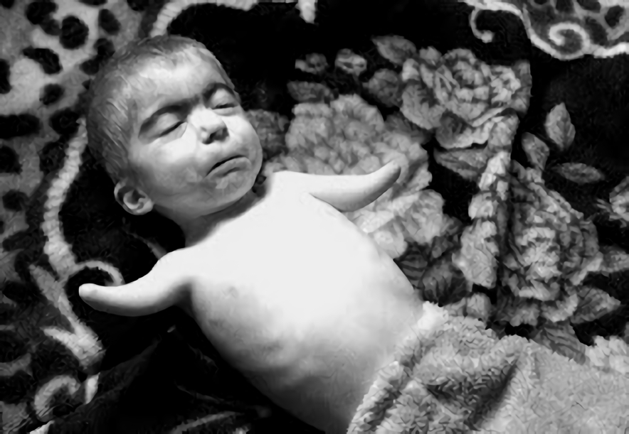 放射能と奇形児　旧ソ…